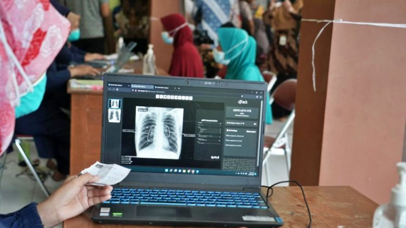 Pentingnya Deteksi Dini dan Investigasi Kontak TBC